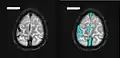 Axiales SWI-Bild der scheitelnahen Duravenen. Die Thrombose ist im rechten Bild blau hervorgehoben.