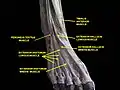 Sektionspräparat mit dem Musculus extensor digitorum brevis